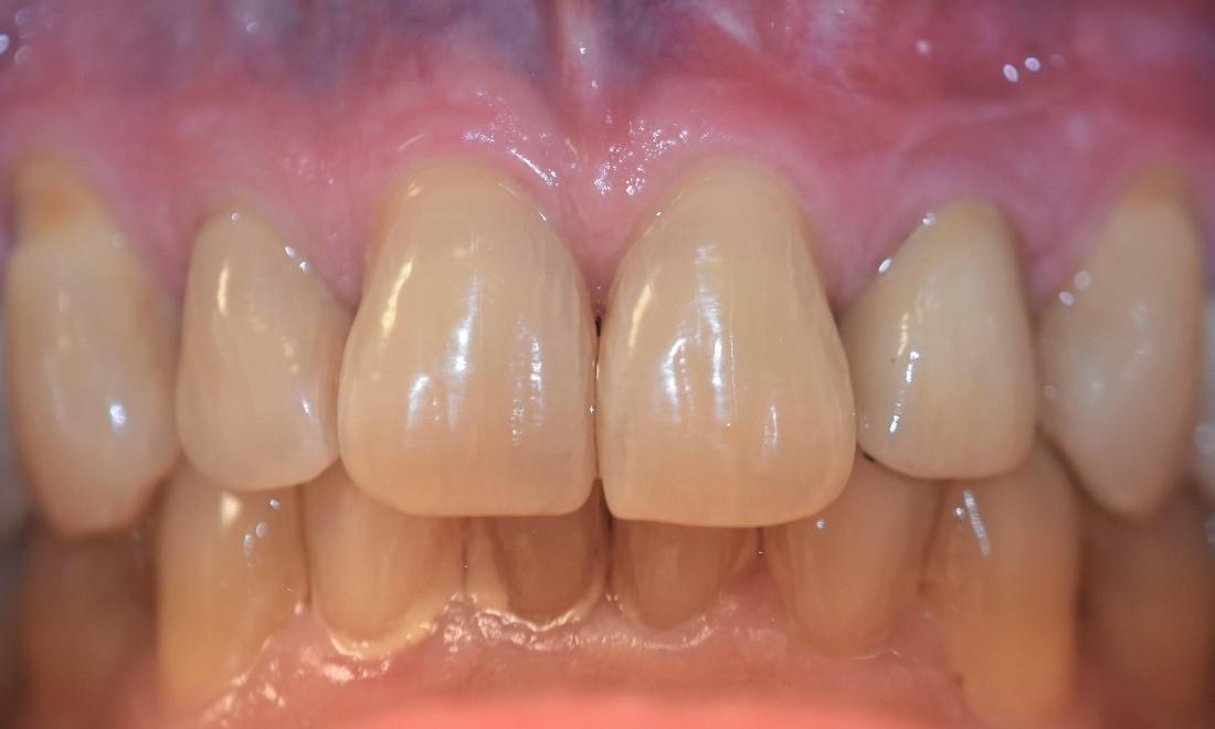 Ohana Dental Smile Gallery Replace Missing Tooth with Implant