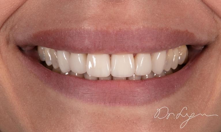 Smile-makeover-After-Image